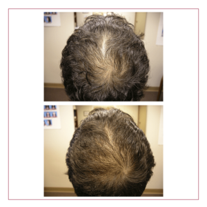 Hair Loss Success Stories - Landmark Hair Loss Clinic