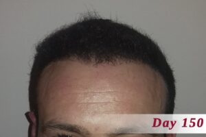 Hair Loss Success Stories - Landmark Hair Loss Clinic