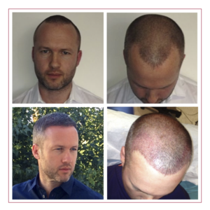 Scott Harrison - Hair Loss Success Stories - Landmark Hair Loss Clinic