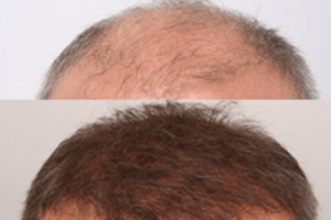 Landmark Hair Loss Clinic - Success Stories