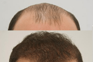 Landmark Hair Loss Clinic - Success Stories