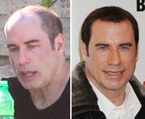 John Travolta before and after hair implant
