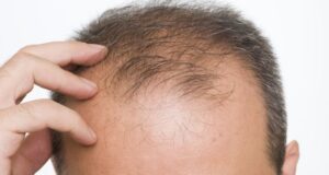 solutions to end hair loss