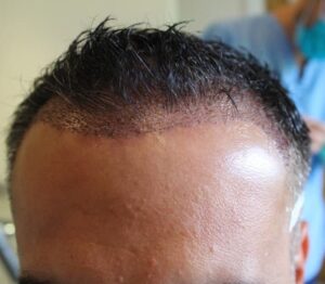 Hair loss solution: Hair Transplants, Will it work for me?