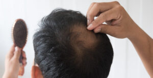 scalp pigmentation landmark hair